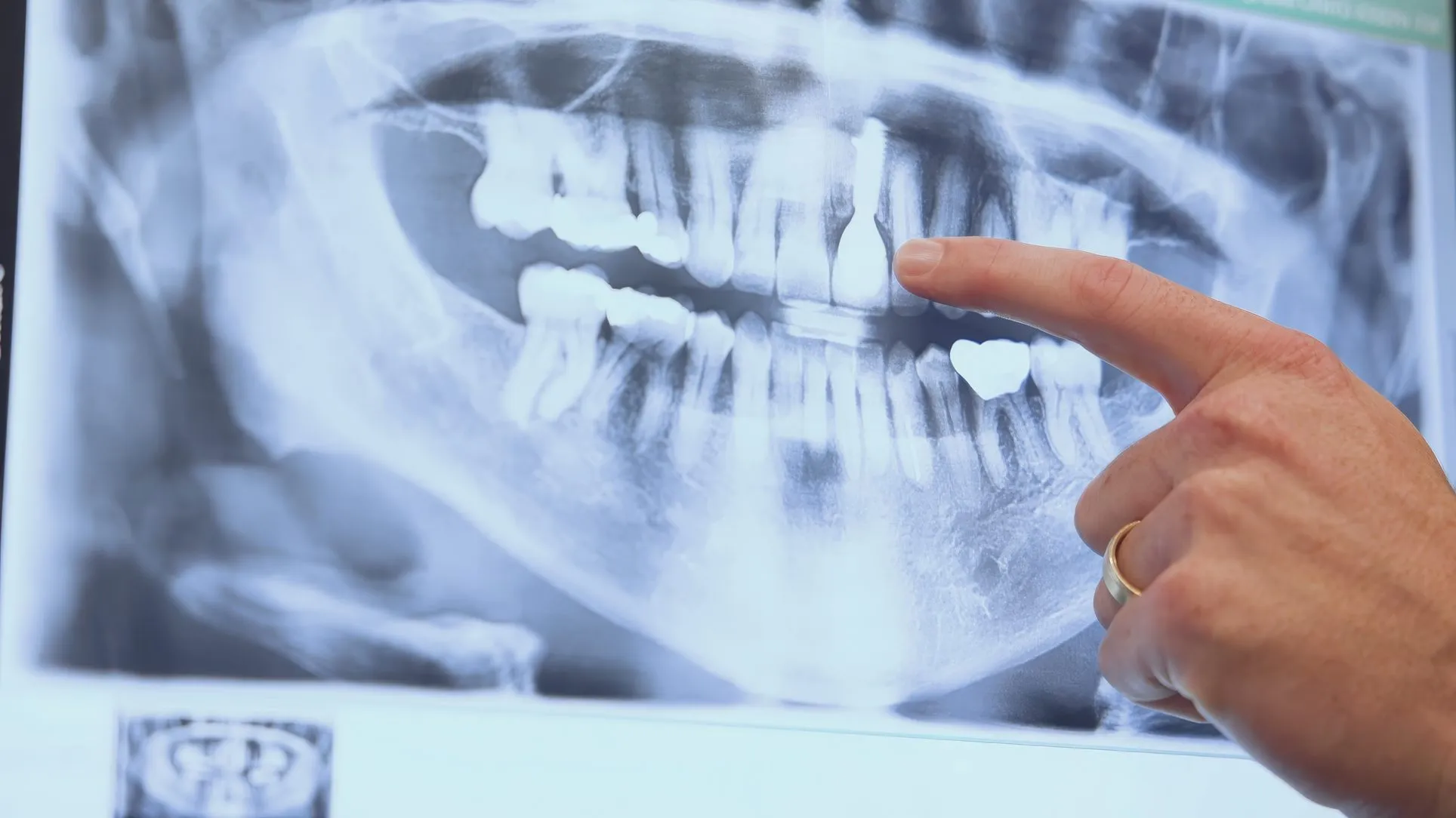A finger pointing to a panoramic X-ray at Cardinal Point Dental in Jacksonville, FL, where full mouth rehabilitation is planned